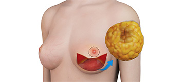 Mastectomy icon