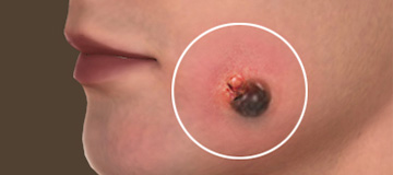 Melanoma Surgery icon