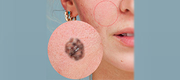 Melanoma Treatment and Reconstruction icon