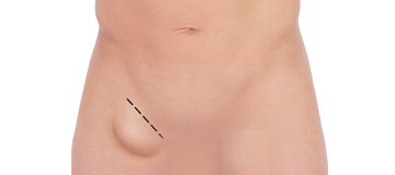 Open Hernia Surgery icon