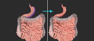 Revision Weight Loss Surgery Icon
