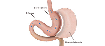 Sleeve Gastrectomy Icon