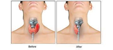 Thyroidectomy icon