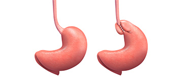 Toupet Fundoplication icon