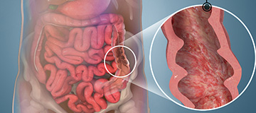 Ulcerative Colitis icon