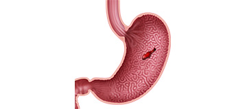 Upper Gastrointestinal Bleeding icon