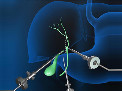 Gallbladder Surgery