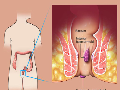 Hemorrhoids