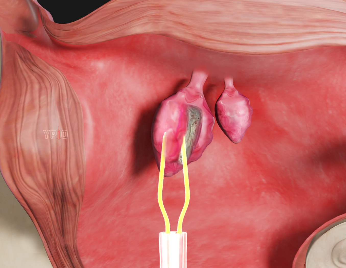 Hysteroscopy with Polypectomy and Fibroid Removal