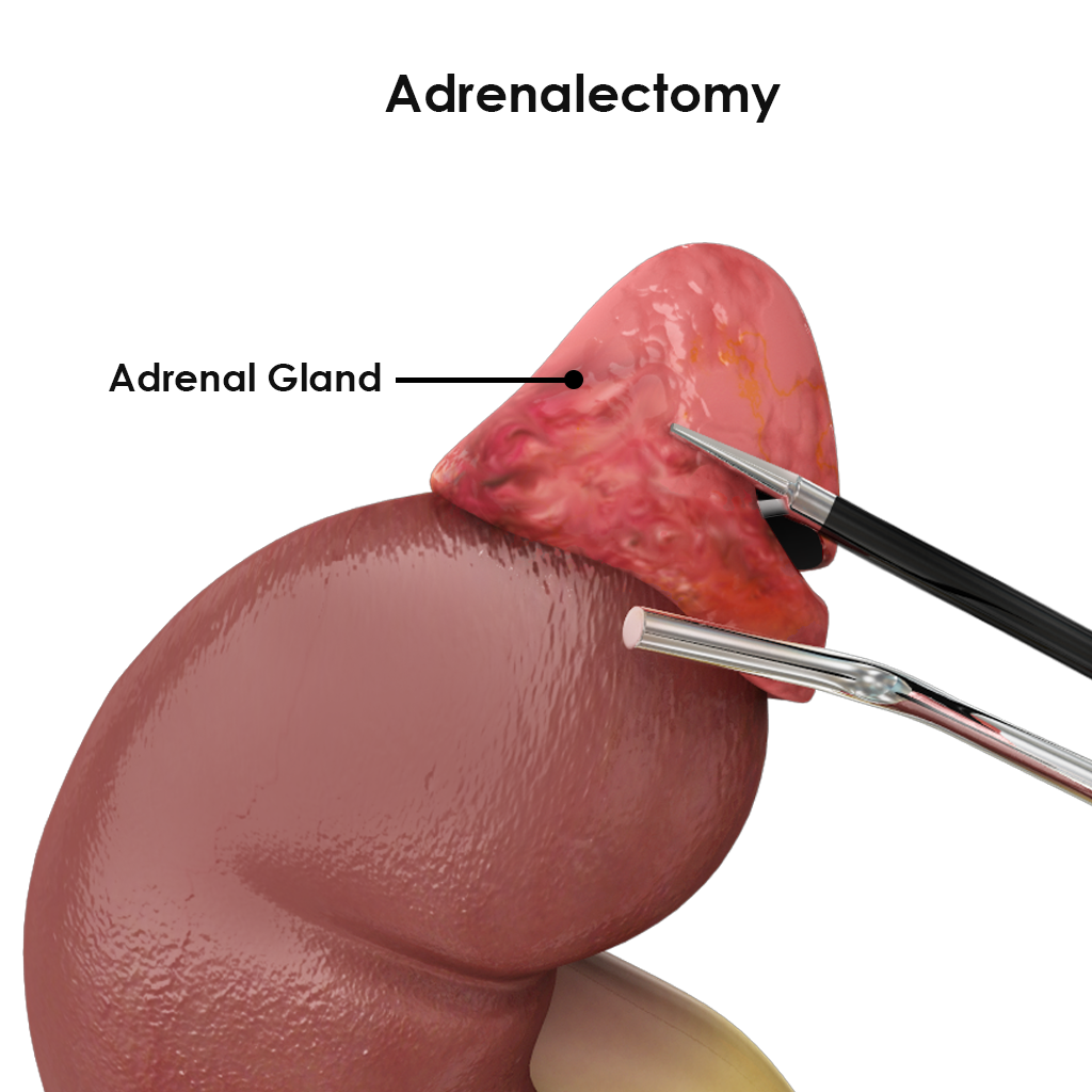 Laparoscopic Adrenalectomy