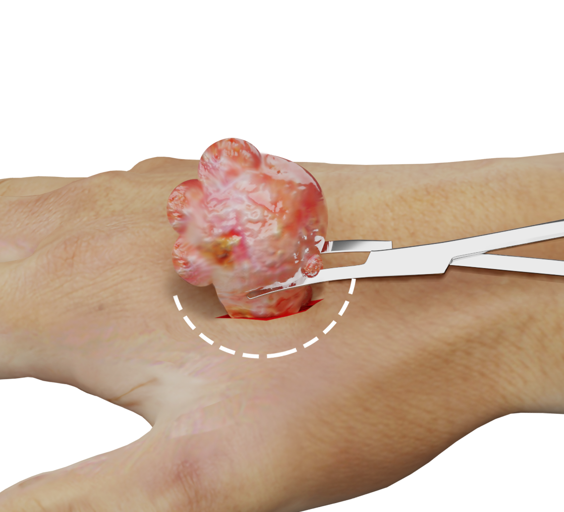 Mass Excision of the Hand and Wrist