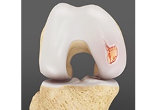 Picture of Articular Cartilage Injury