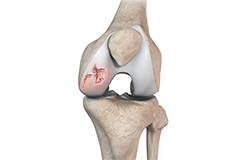 Picture of Chondral or Articular Cartilage Defects