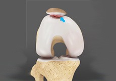 Picture of Chondromalacia Patella