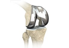 Picture of Custom-fitted Total Knee Arthroplasty