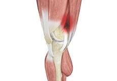 Picture of Iliotibial Band Syndrome
