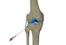 Picture of Intra-articular Knee Injection