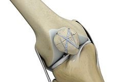 Picture of Knee Fracture Surgery