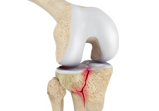 Picture of Knee Fracture