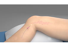 Picture of Knee Laser Treatment