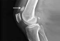 Picture of Loose Bodies in the Knee