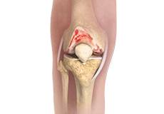 Picture of Knee Osteoarthritis