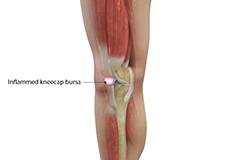 Picture of Kneecap Bursitis