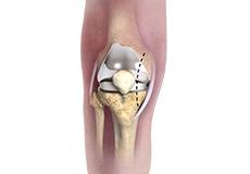 Picture of Lateral Approach Total Knee Replacement