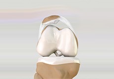 Picture of Lateral Patellar Compression Syndrome