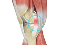 Picture of MCL Sprains