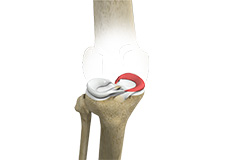 Picture of Medial Meniscus Syndrome