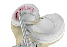 Picture of Meniscal Surgery