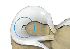 Picture of Meniscal Tear