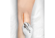 Picture of Minimally Invasive Knee Joint Replacement