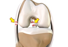 Picture of Multiligament Instability