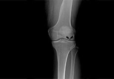 Picture of Osteonecrosis of the Knee