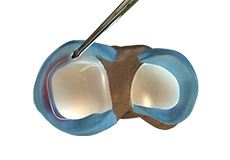 Picture of Partial Arthroscopic Meniscectomy
