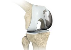Picture of Partial Lateral Knee Replacement