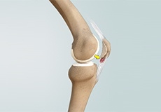 Picture of Patellar Tendinitis