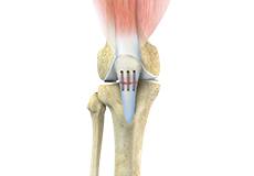 Picture of Patellar Tendon Repair