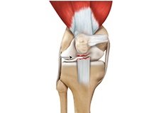 Picture of Patellar Tendon Rupture
