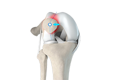 Picture of Patellar Tracking Disorder