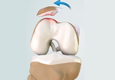 Picture of Patellofemoral Instability
