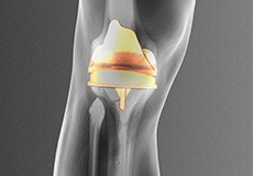 Picture of Patient Specific Knee Replacement