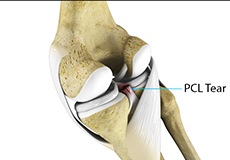 Picture of PCL Injuries