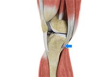 Picture of Pes Anserine Bursitis