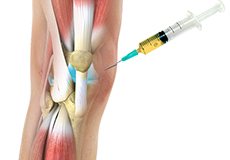 Picture of Platelet-Rich Plasma (PRP) Injections for the Knee