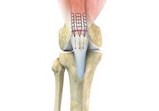 Picture of Quadriceps Tendon Repair