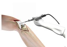 Picture of Robotic Assisted Partial Knee Surgery