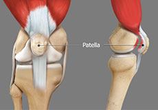 Picture of Runner's Knee